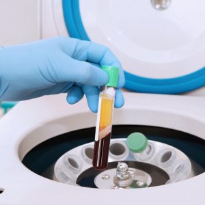 juventix-prp-difference1